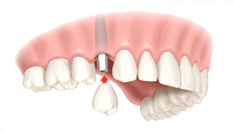 Single dental implant with crown, abutment, and titanium post